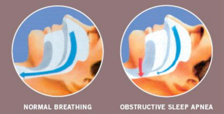 comparison of normal breathing and obstructive sleep apnea